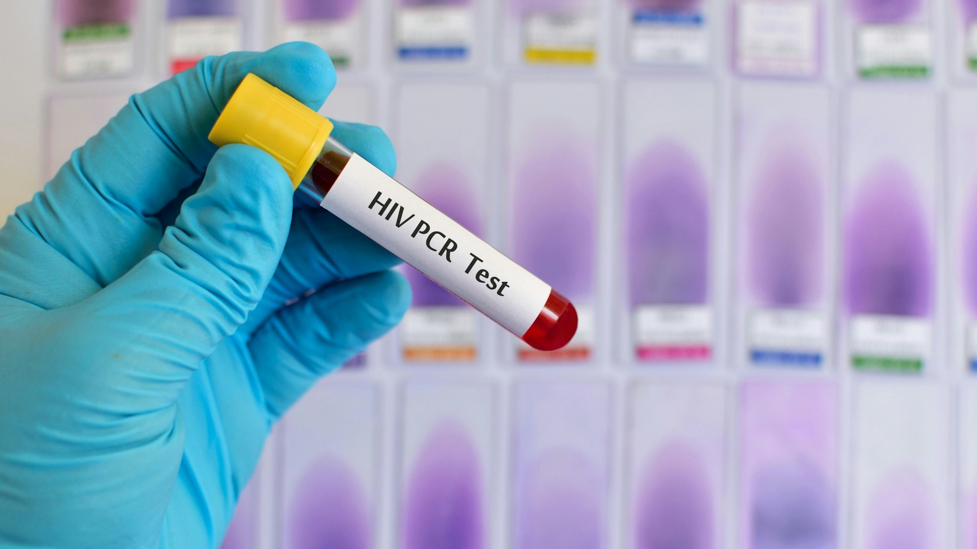 HIV PCR Test, medical concept, Human Immunodeficiency Virus Positive test